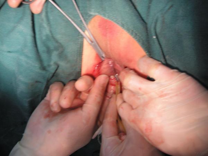 肛门湿疹肛引起周脓肿手术图片