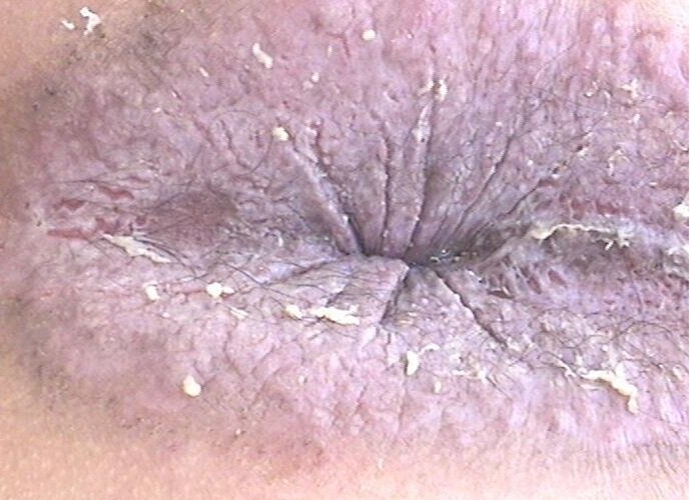 肛门湿疹脱皮的图片
