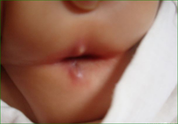 婴儿肛门湿疹有包图片