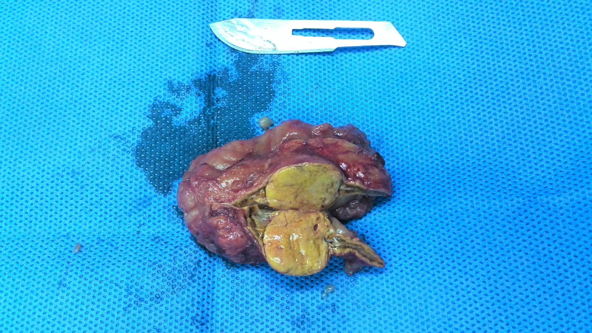 剖开的肾上腺肿瘤小肿瘤高清图片