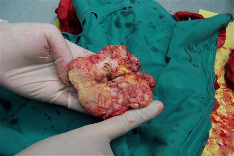 切除的巨大肾上腺肿瘤图片