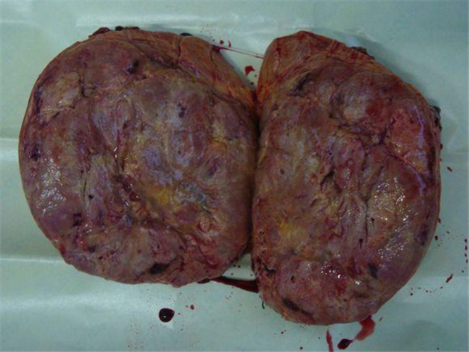 切开的肾上腺肿瘤图片