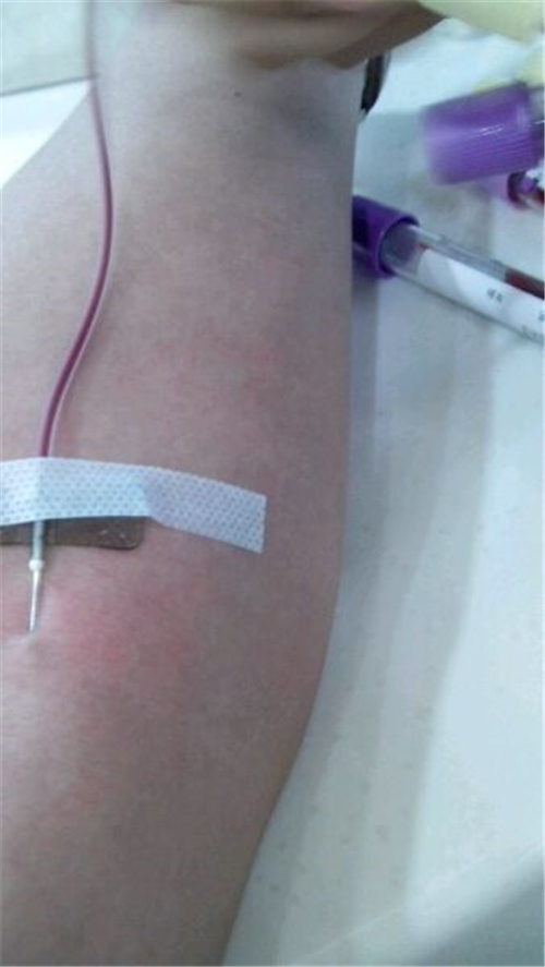 输血图片女生手臂图片