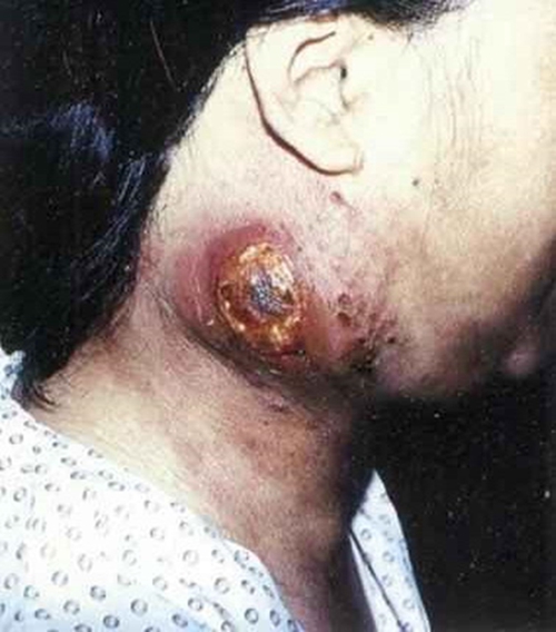 急性淋巴管炎的图片图片