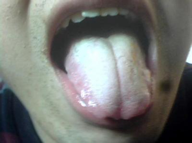 淋巴结口腔发炎舌头下面的图片