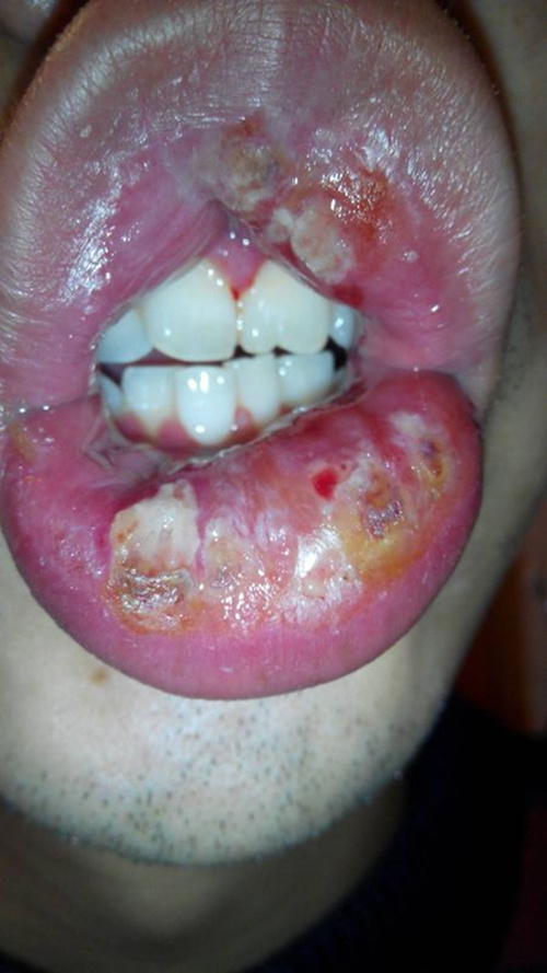 淋巴结口腔外嘴唇的发炎的图片