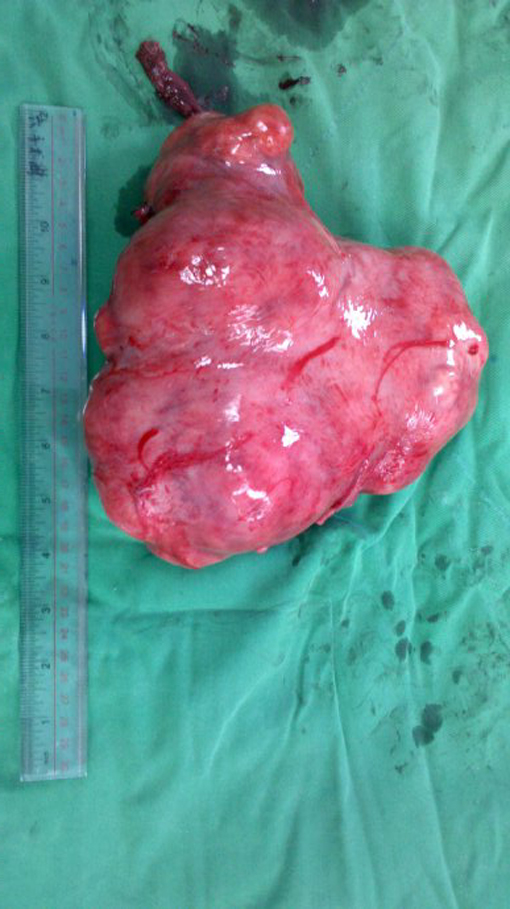 多发性子宫肌瘤手术图片