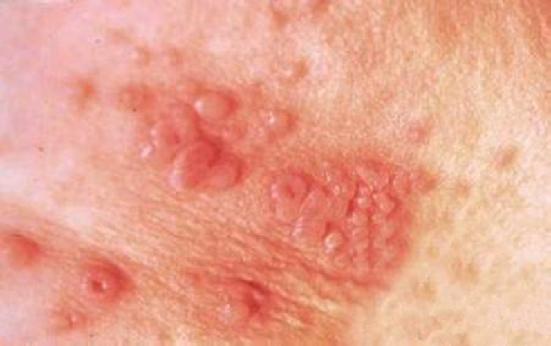 女性梅毒疹症状图片图片