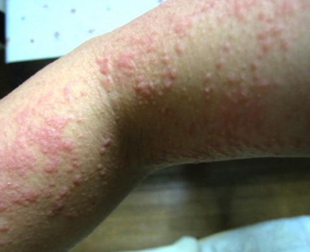 寒冷性荨麻疹患者的图片