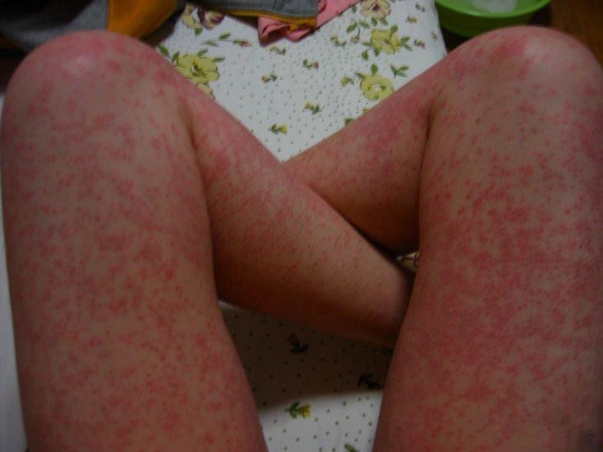 冷空气荨麻疹图片