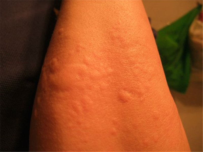 寒冷型荨麻疹初期的症状图片