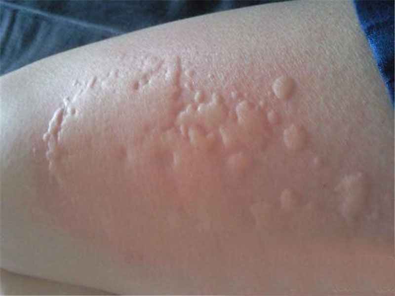 寒冷性荨麻疹手背皮肤病图片
