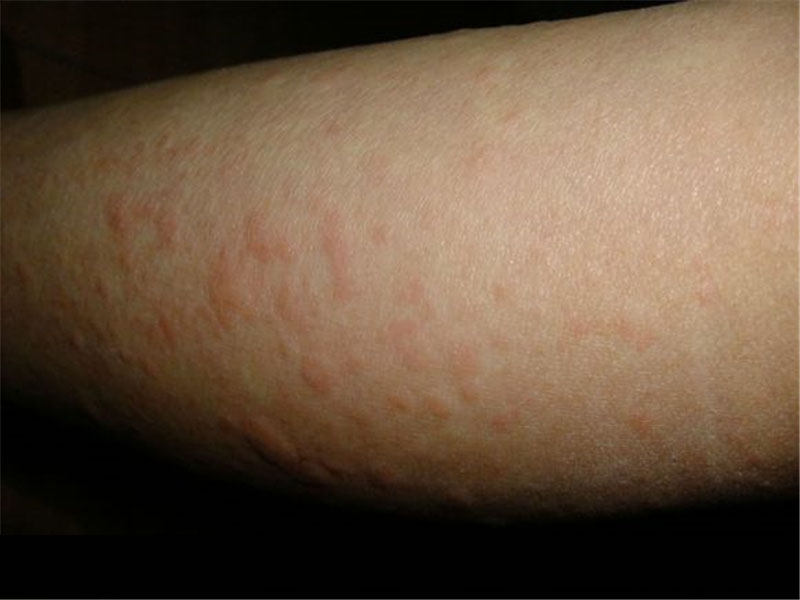 冷性荨麻疹症状的图片