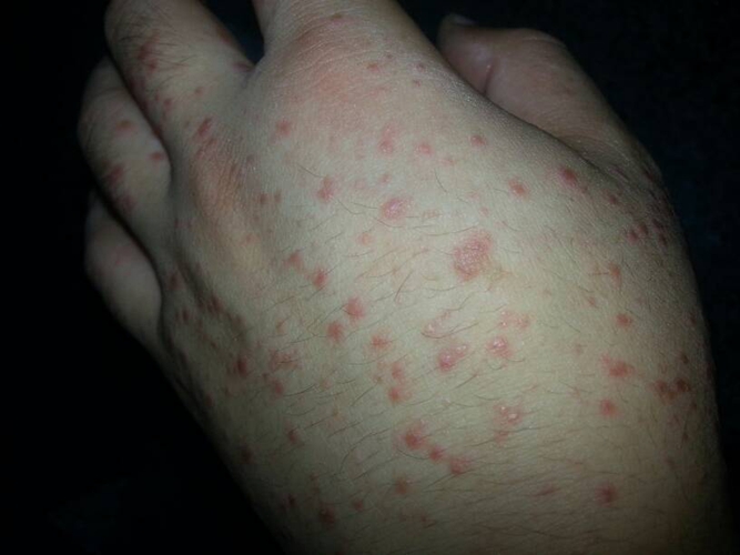 手背长寒冷性荨麻疹严重图片