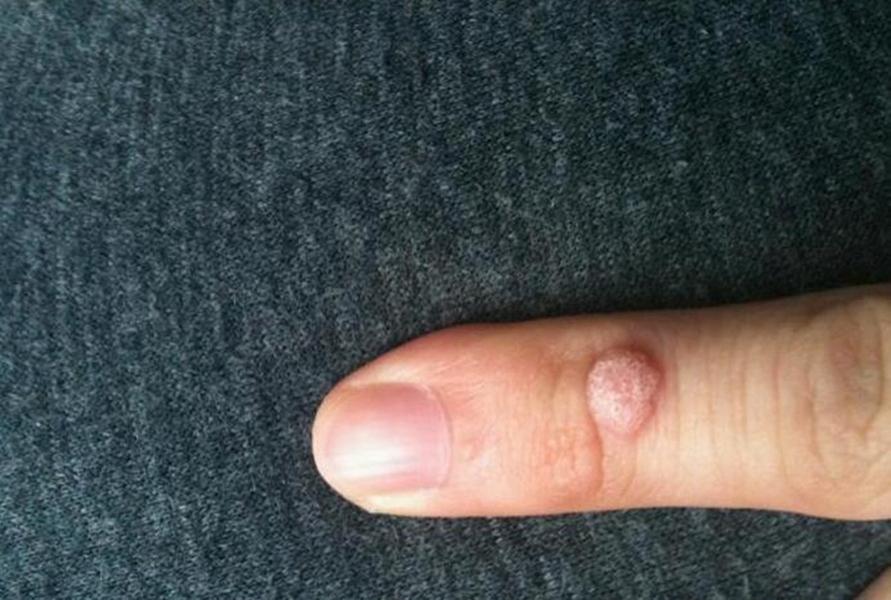 手指早期丝状疣的图片