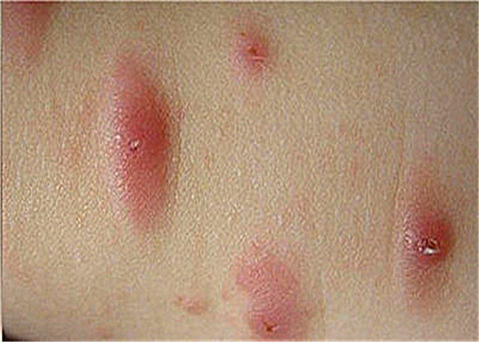 衣服勒痕处发性荨麻疹图片