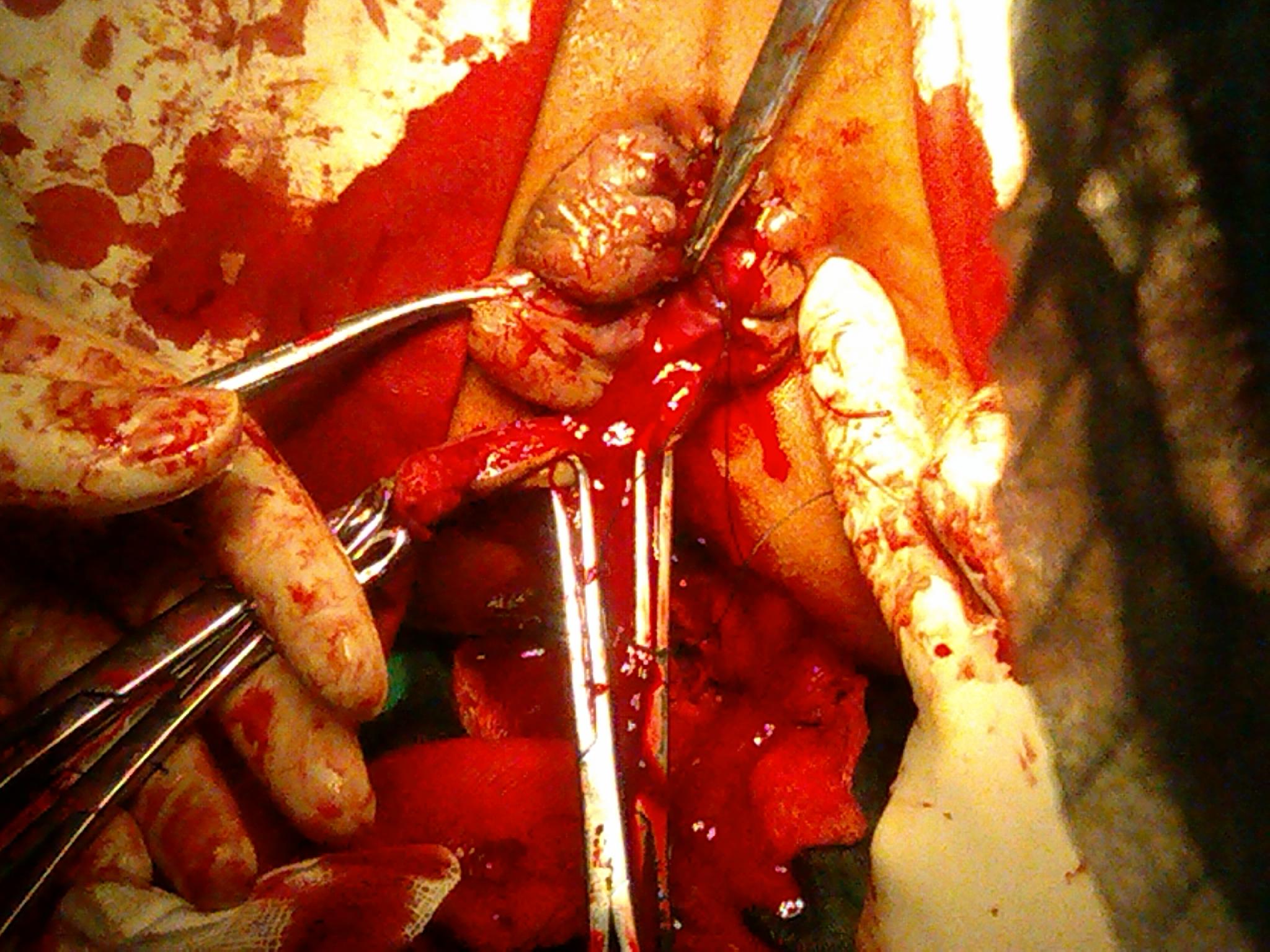 血栓性外痔手术过程图图片
