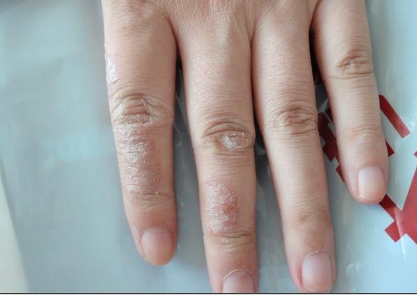 手癣初期症状图片图片