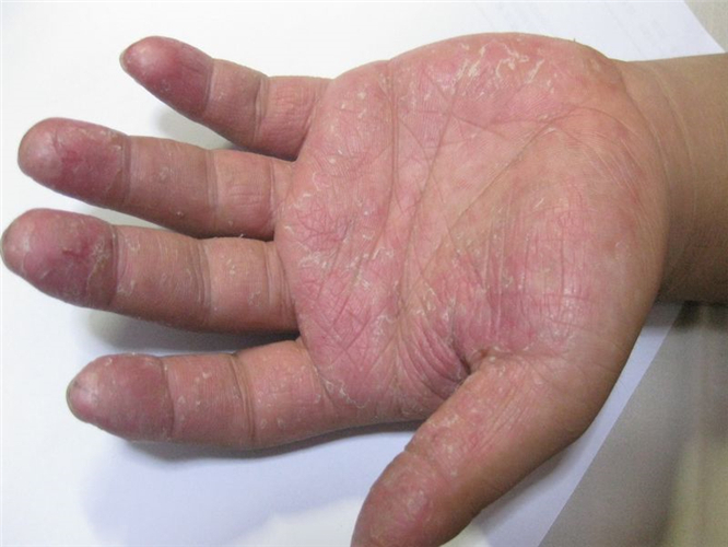 湿疹手癣症状图片