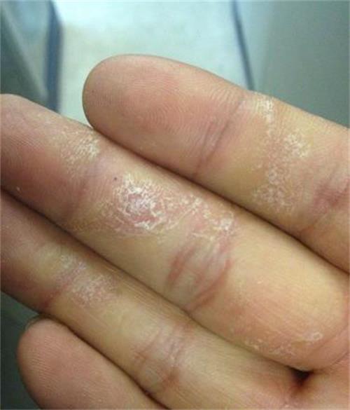 湿疹手癣症状图片