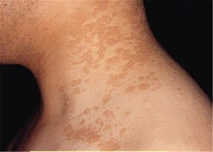 花斑癣婴幼儿脖子上皮肤症状图片