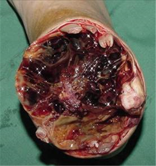 骨肉瘤早期症状图片图片