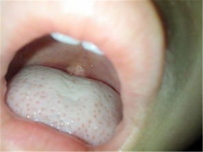 急性扁桃体炎症状表现之舌苔发白图片