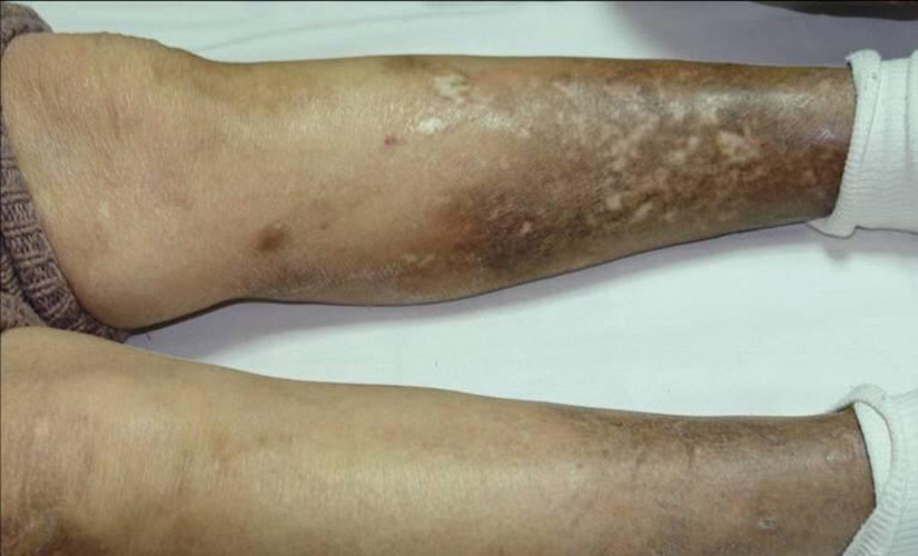 双腿的放射性皮炎图片