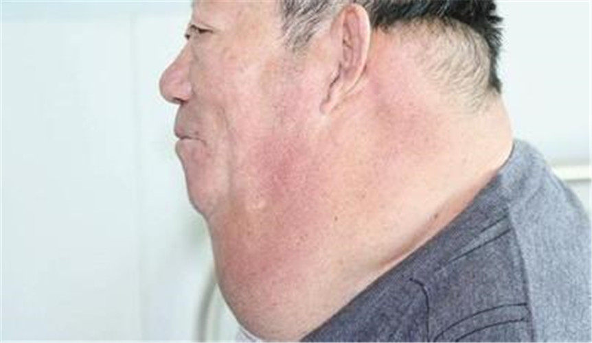 颈部大脂肪瘤图片
