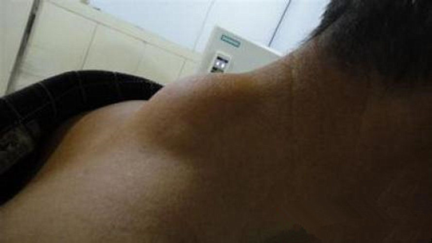 男子后颈部脂肪瘤图片