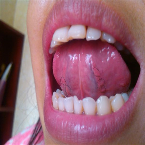 口腔腭咽弓部囊肿图片图片