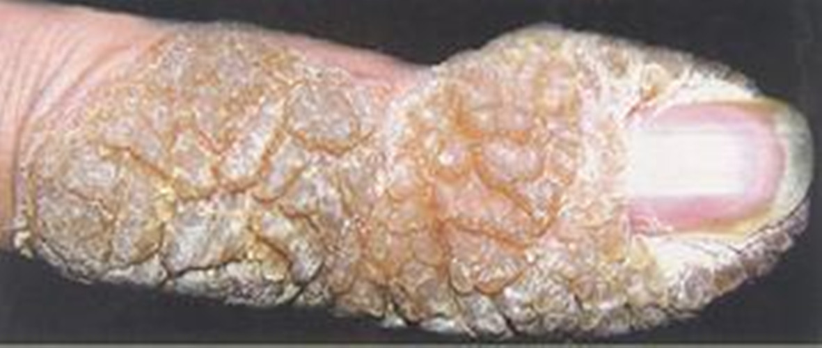 大拇指的皮肤结核病图片