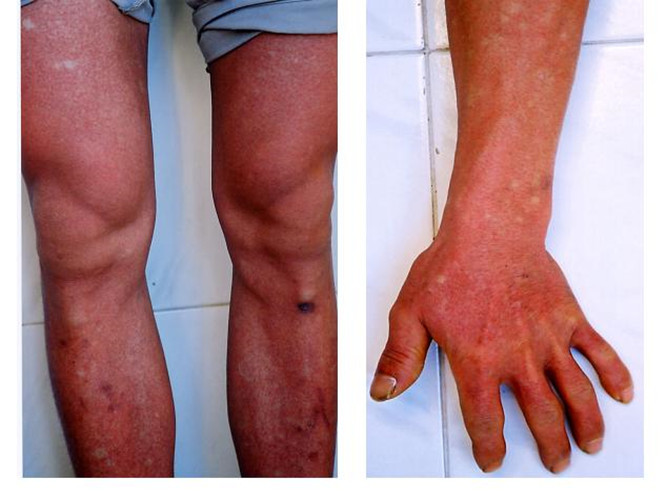 上肢和下肢的皮肤结核病的图片