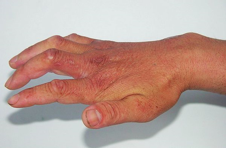 手部的皮肤结核病表现图片