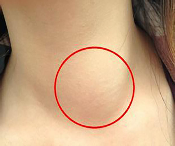 甲状腺瘤的左侧早期症状图片