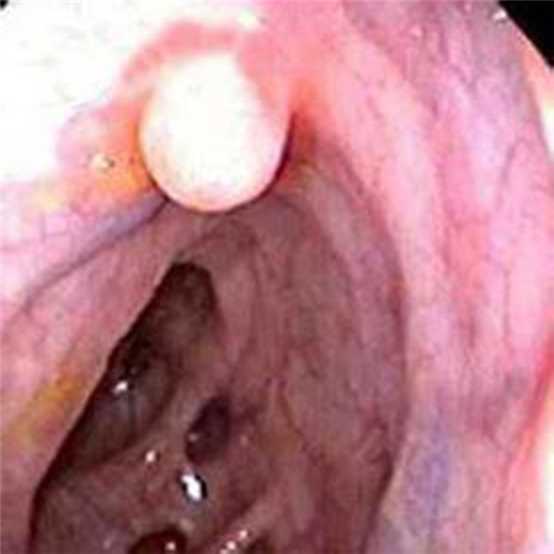 腺瘤性直肠息肉的图片