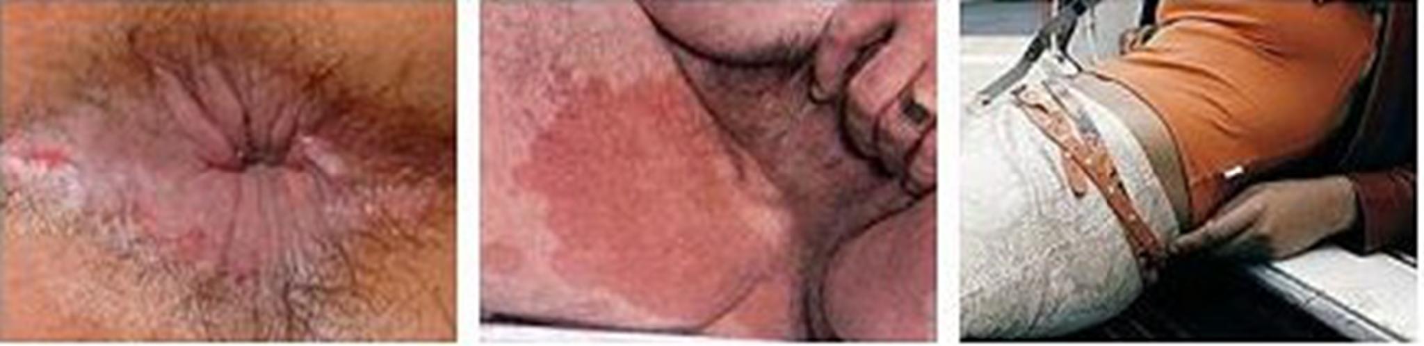 肛门湿疹示意图图片