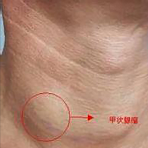 甲状腺瘤右侧早期症状图片