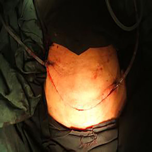 巨大甲状腺瘤手术图片