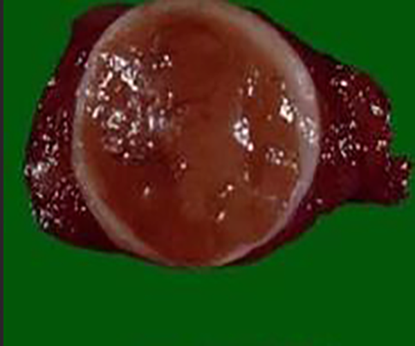 切除后的甲状腺瘤的肿瘤图片