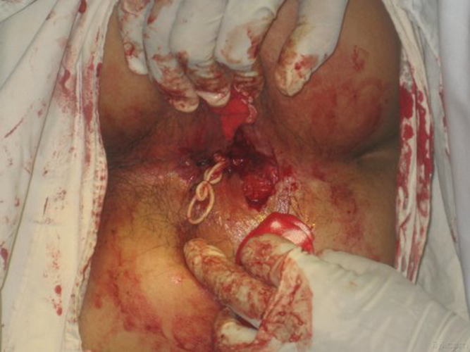 肛门湿疹肛周脓肿手术图片