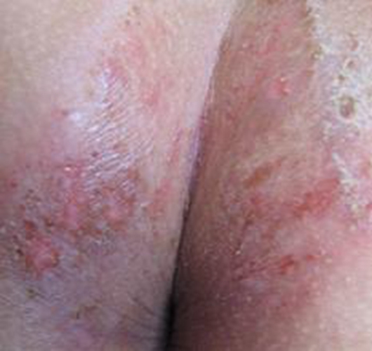 肛周湿疹早期症状图片图片