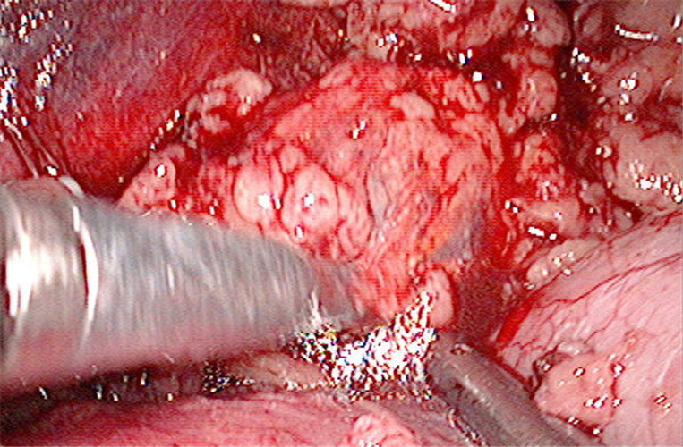 腹腔镜下的肾上腺肿瘤图片