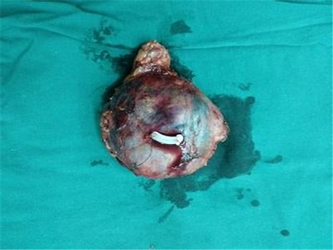 切除的右侧肾上腺肿瘤图片
