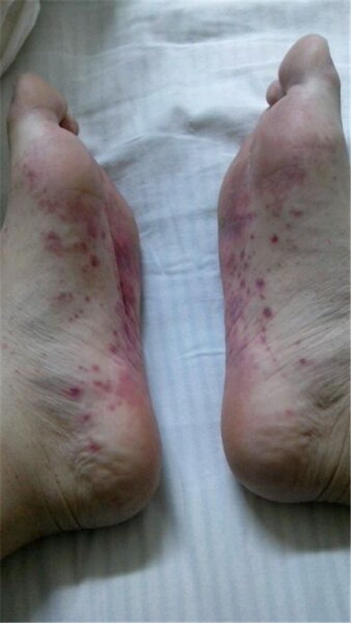 再生障碍性贫血双脚图片