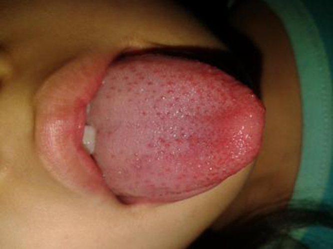 淋巴结口腔发炎舌头表面的图片