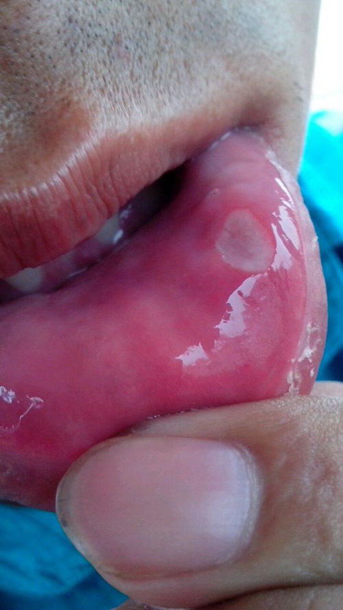 口腔粘膜炎症 淋膜图片