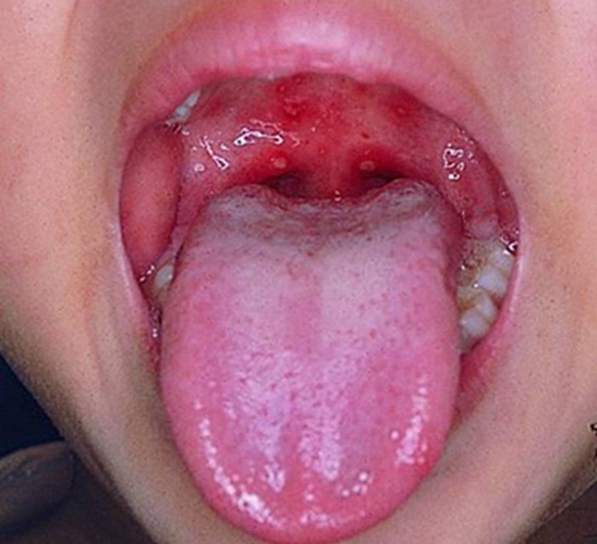 淋巴结前期的口腔发炎的图片