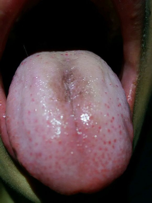 淋巴结前期口腔舌头上的        发炎图片
