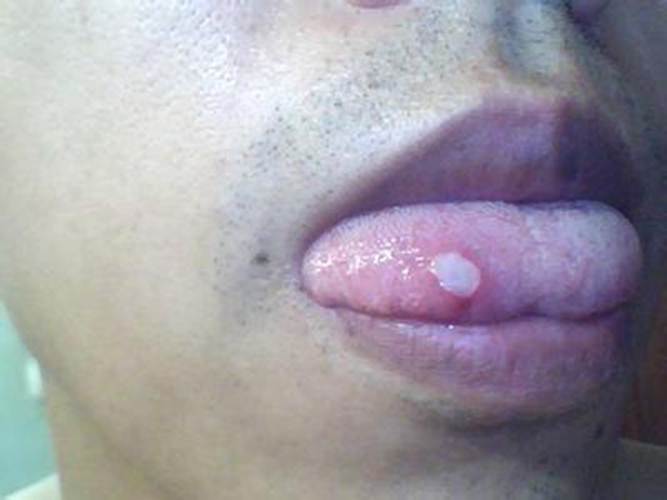 淋巴结前期口腔发炎舌尖的图片